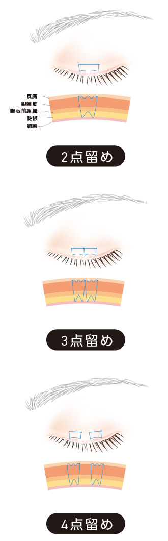 二重施術(自然癒着法)