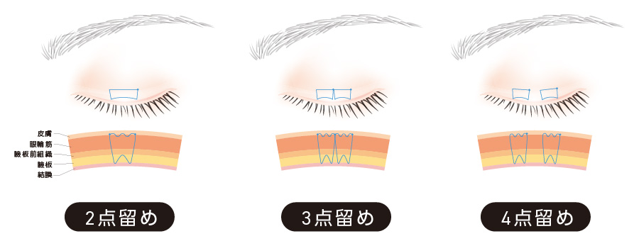 二重施術(自然癒着法)