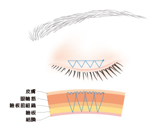 二重施術(埋没法)